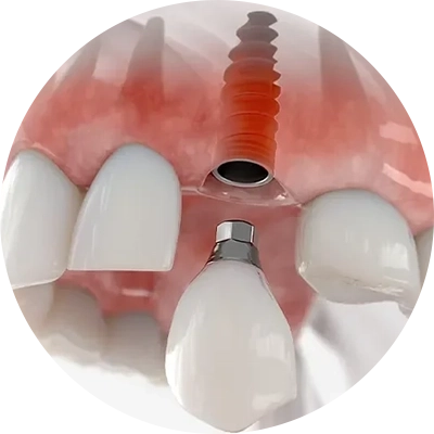 Implantologie Dentaire