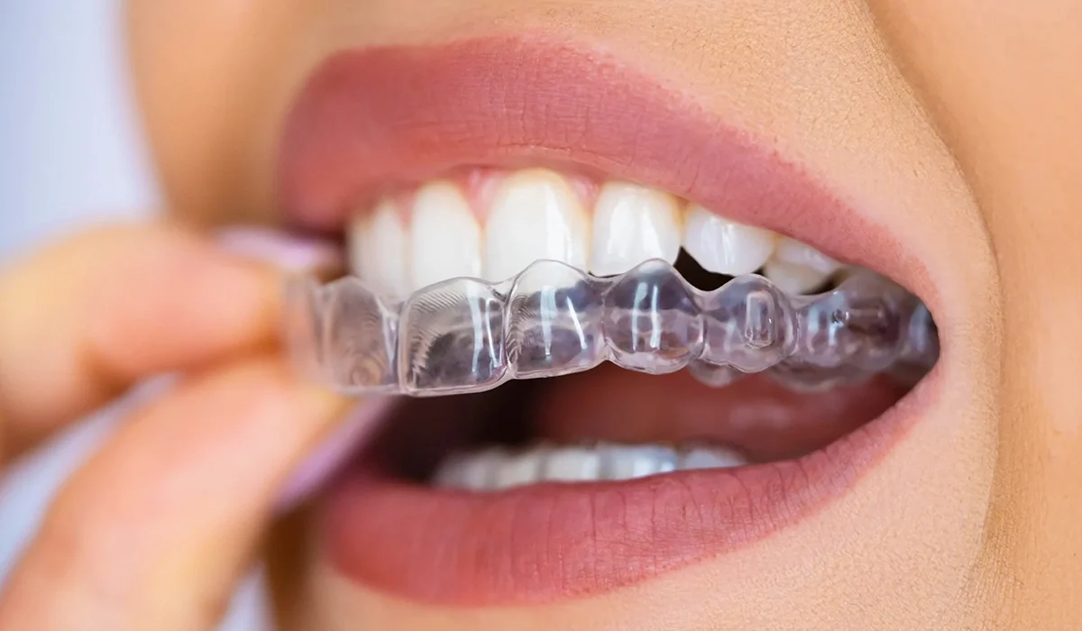 Aligneurs transparents (Invisalign) Discrétion et efficacité - Dr Jihene Helal - Médecin dentiste - Tunisie - Sousse