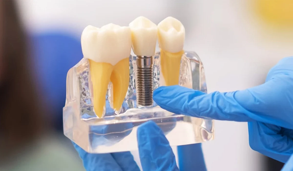 Implantologie Dentaire