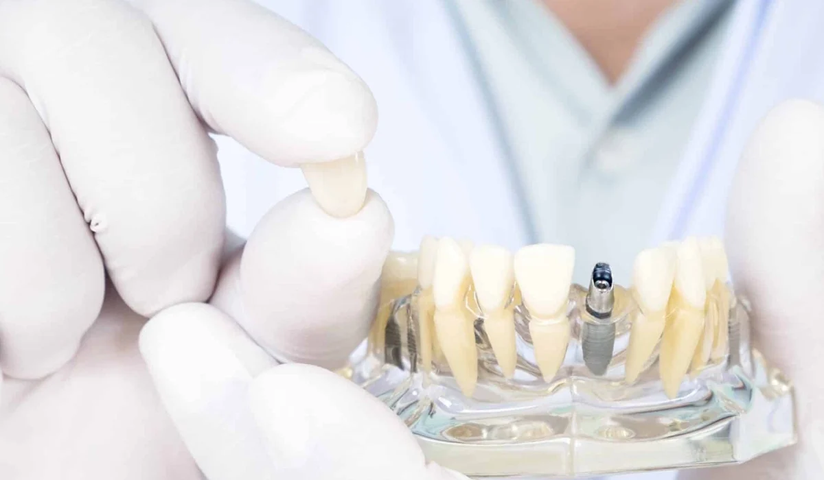 Implantologie Dentaire