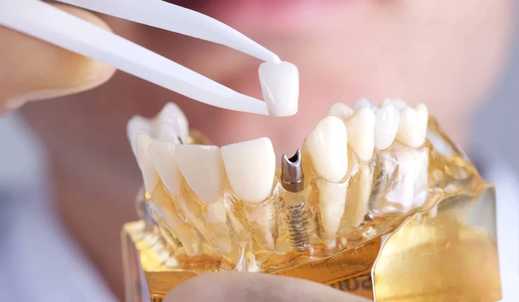 Kératine naturelle pour restaurer l’émail - Dr Jihene Helal - Médecin dentiste - Tunisie - Sousse