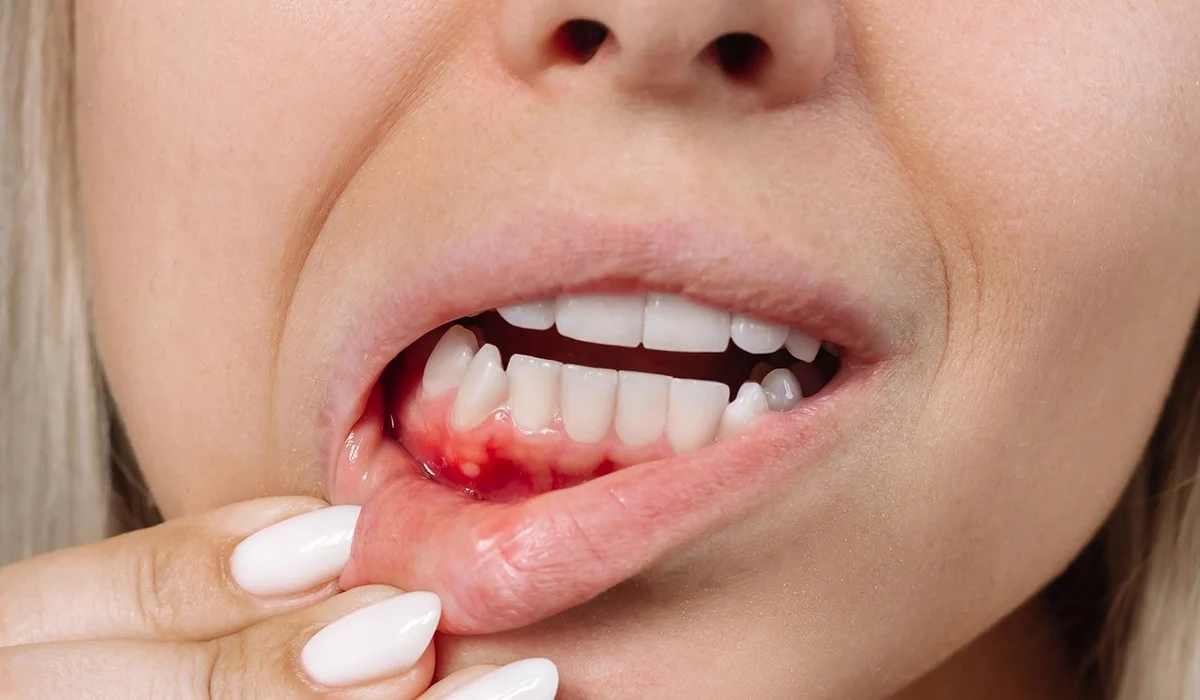 Pourquoi mes gencives saignent-elles Les causes et solutions expliquées par un dentiste - Dr Jihene Helal - Médecin dentiste - Tunisie - Sousse