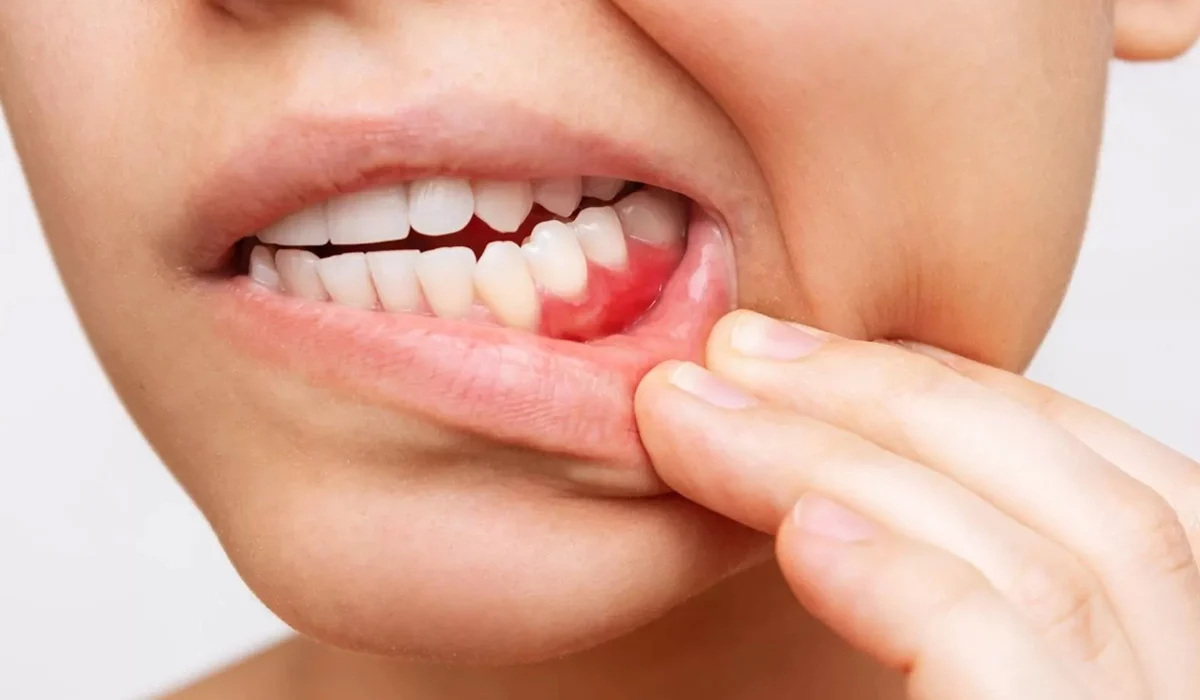 Tabac, Stress et Autres facteurs de risque pour les gencives - Dr Jihene Helal - Médecin dentiste - Tunisie - Sousse