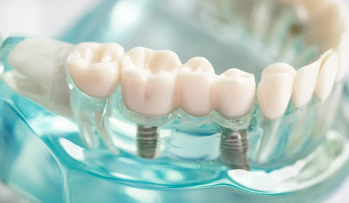 Zircone et céramique pour prothèses dentaires Esthétique et durabilité - Dr Jihene Helal - Médecin dentiste - Tunisie - Sousse