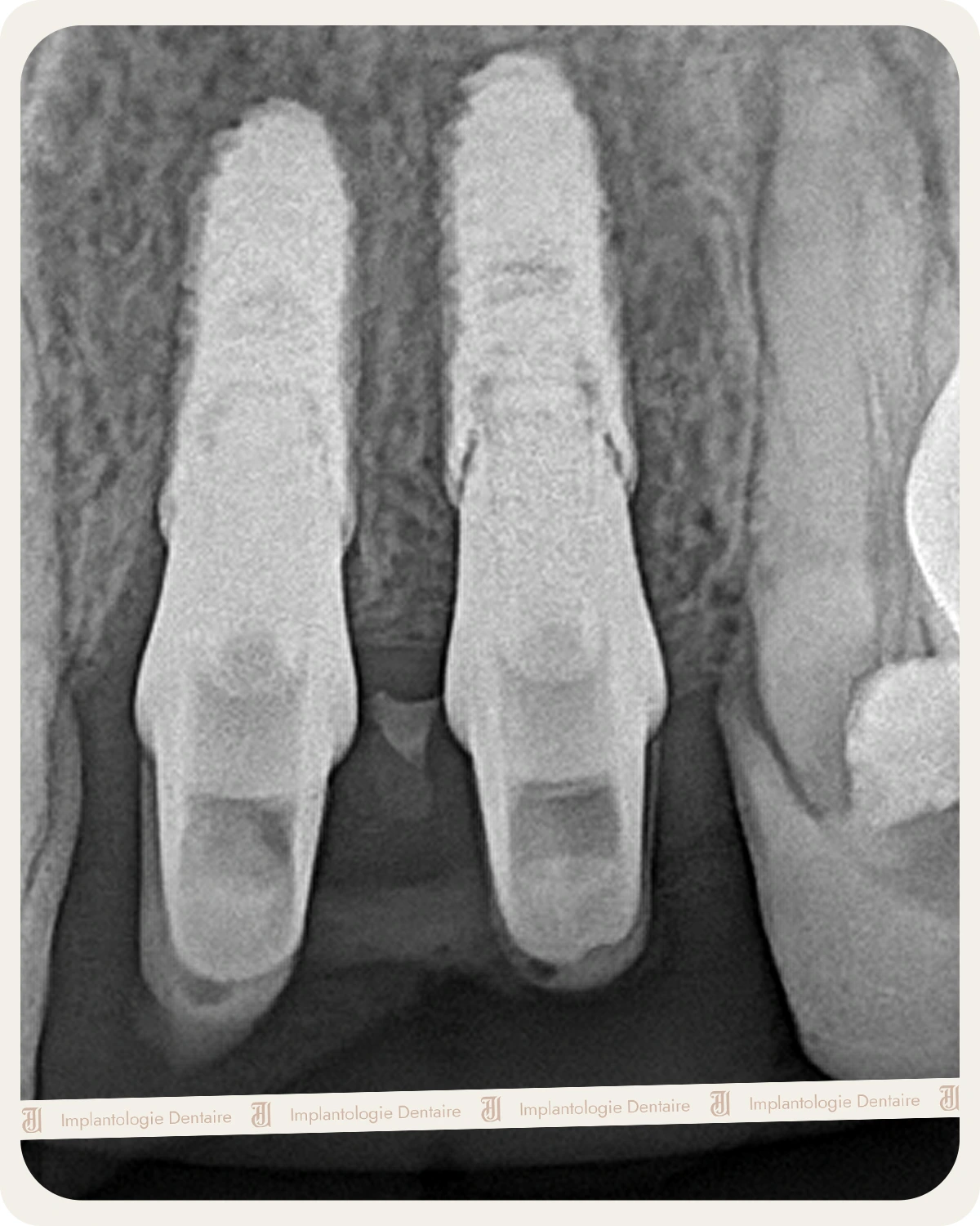 Implantologie Dentaire