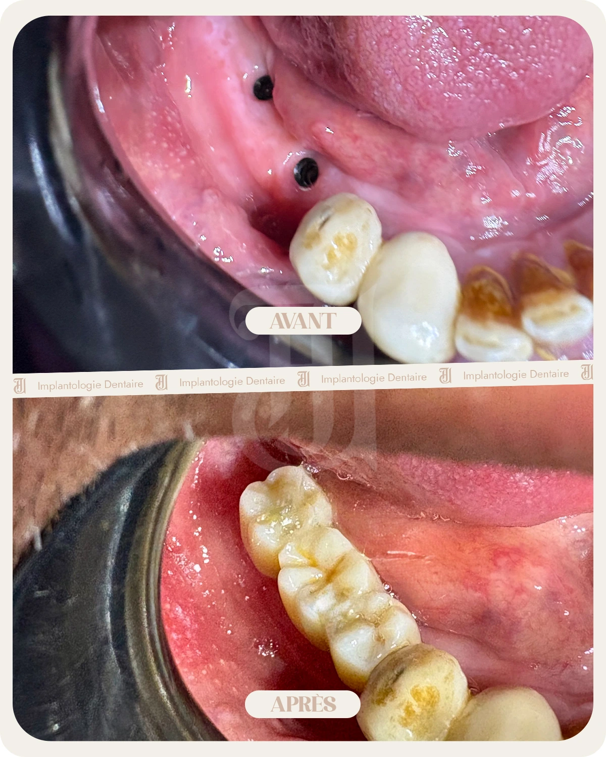 Implantologie Dentaire