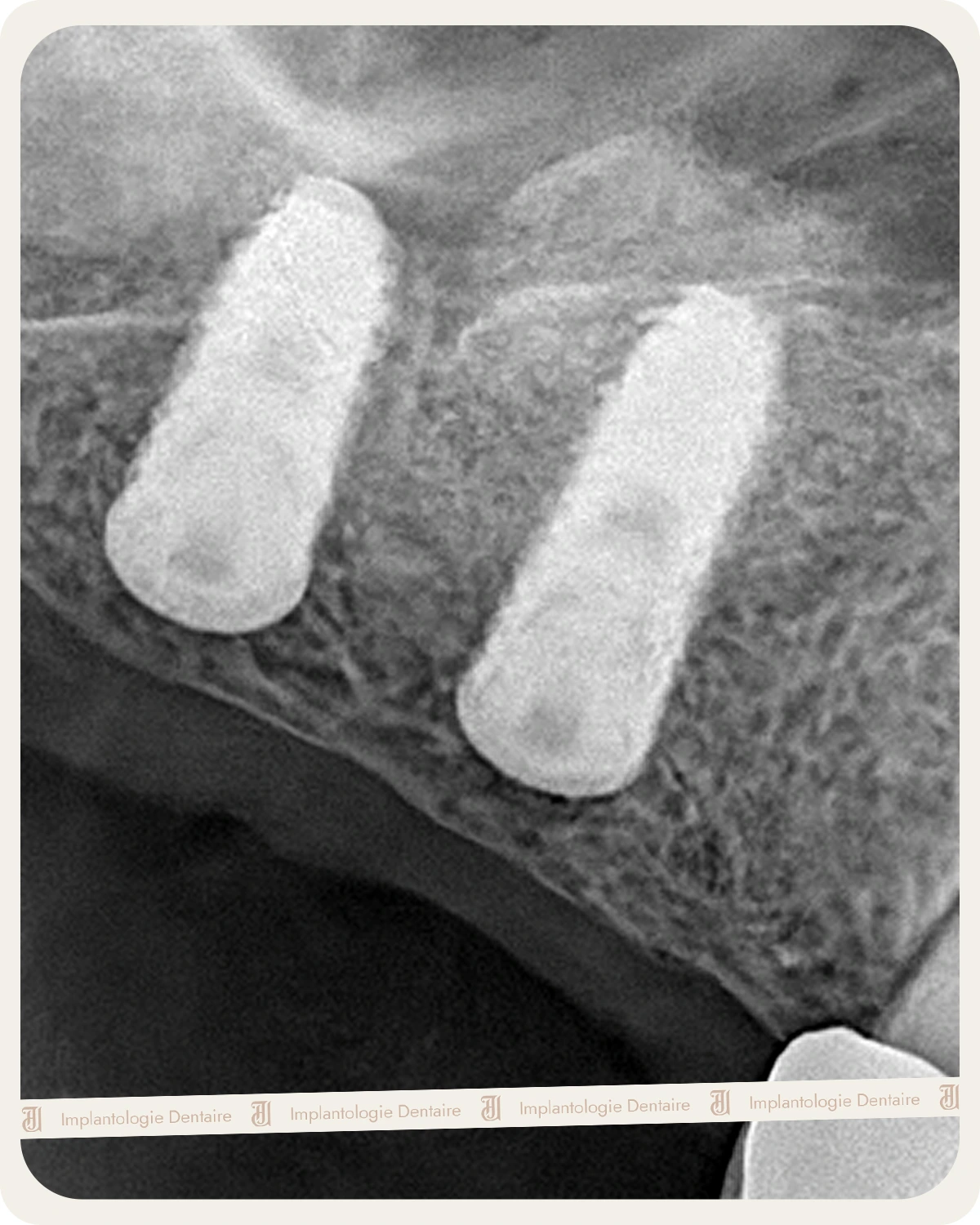 Implantologie Dentaire